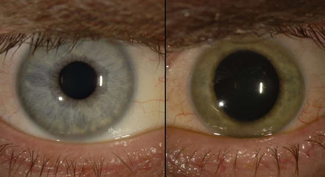 بعد تعافيه بشهور.. إيبولا داخل عيون طبيب أمريكي ويحول لونهما من الأزرق إلى الأخضر