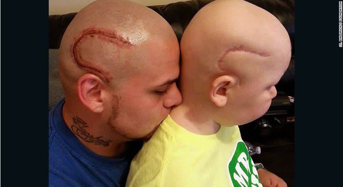 أب يضع وشماً على شكل ندبة لدعم طفله في مواجهة سرطان المخ 