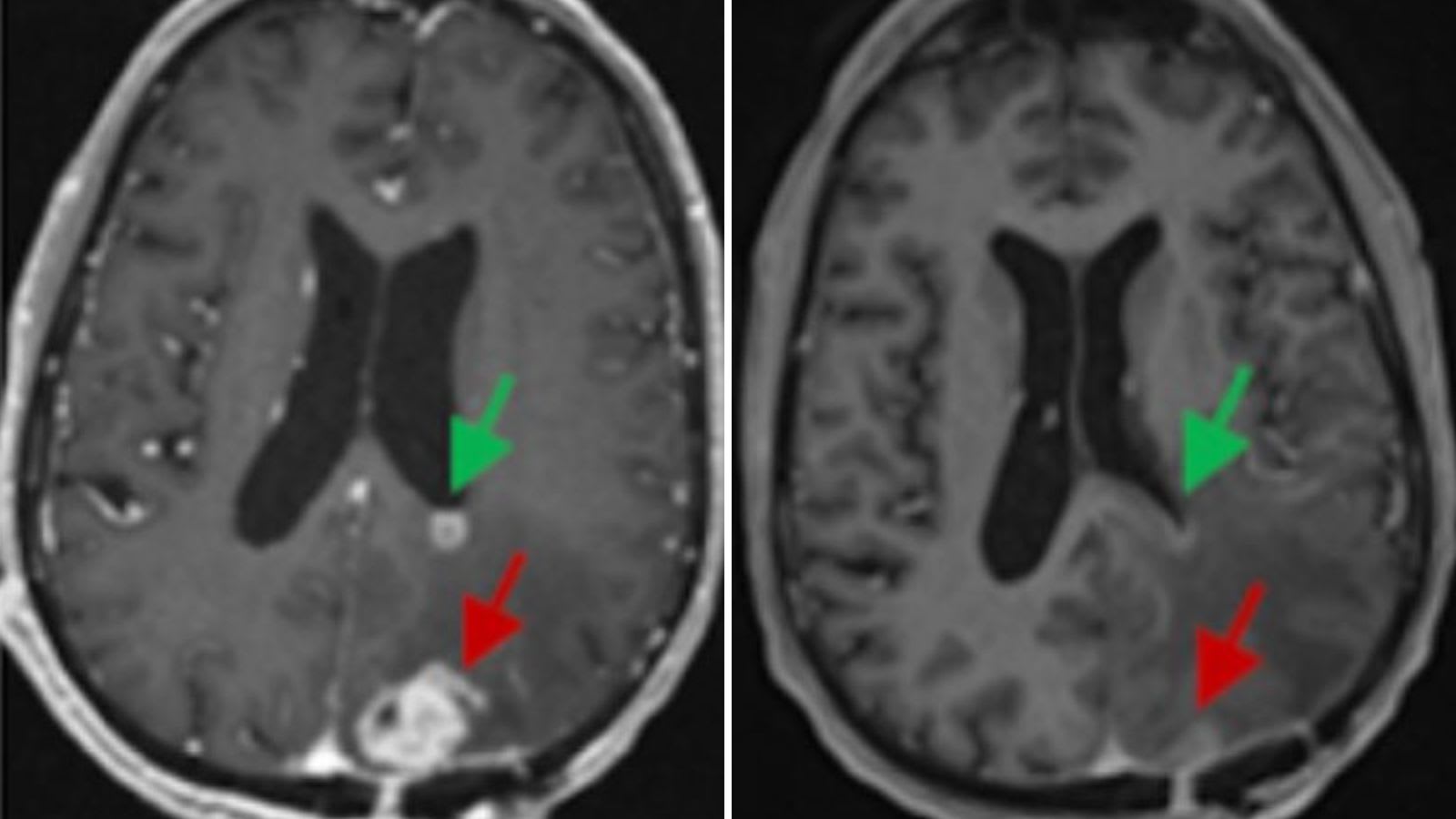 20240313-brain-tumor-reduction-split.jpg