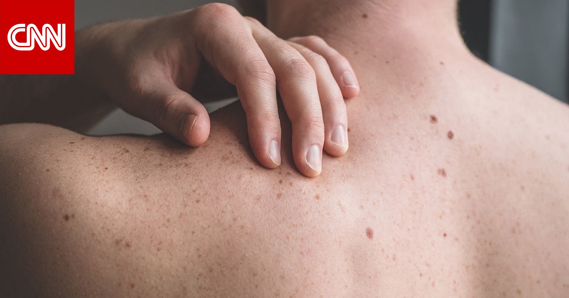 حروق الوجه والجسم..ما أسبابها وكيفية علاجها في المنزل؟ 