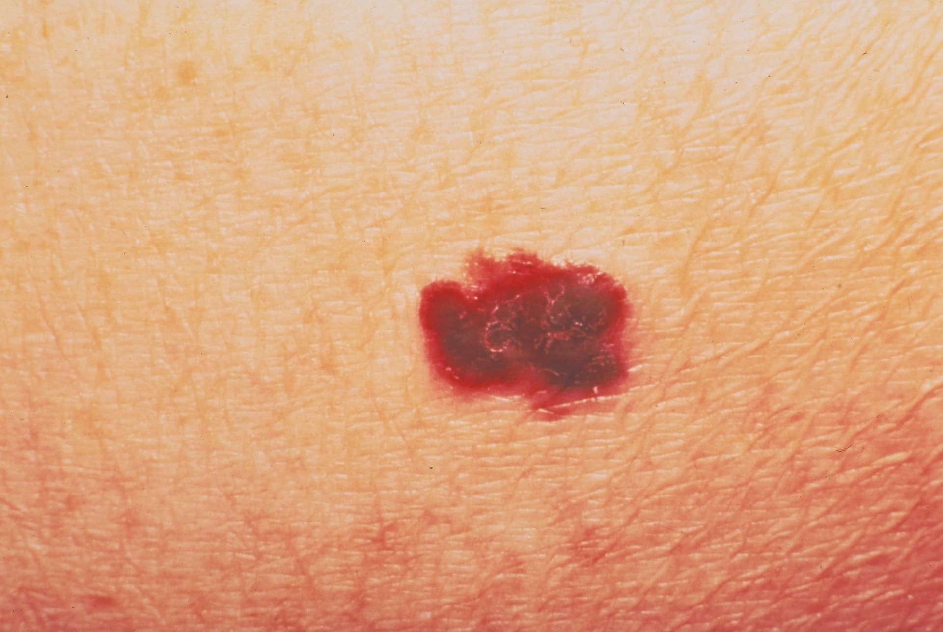 أطباء يحذرون من أن التطبيقات التي تدّعي اختبار الشامات لا تستطيع اكتشاف سرطانات الجلد