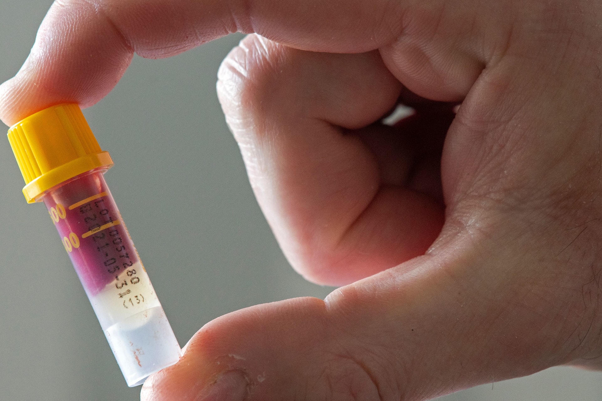 المملكة المتحدة تعتزم اجراء اختبار دم تجريبي قد يكشف عن 50 نوعاً من السرطان