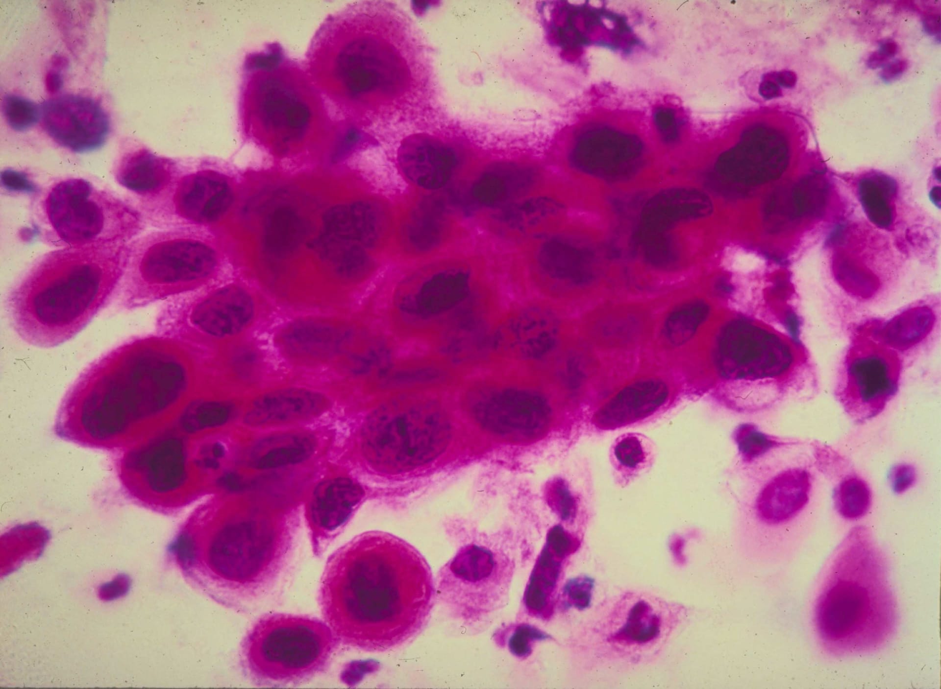 هل لقاحات فيروس كورونا آمنة لمرضى السرطان؟هذا ما يقوله الخبراء