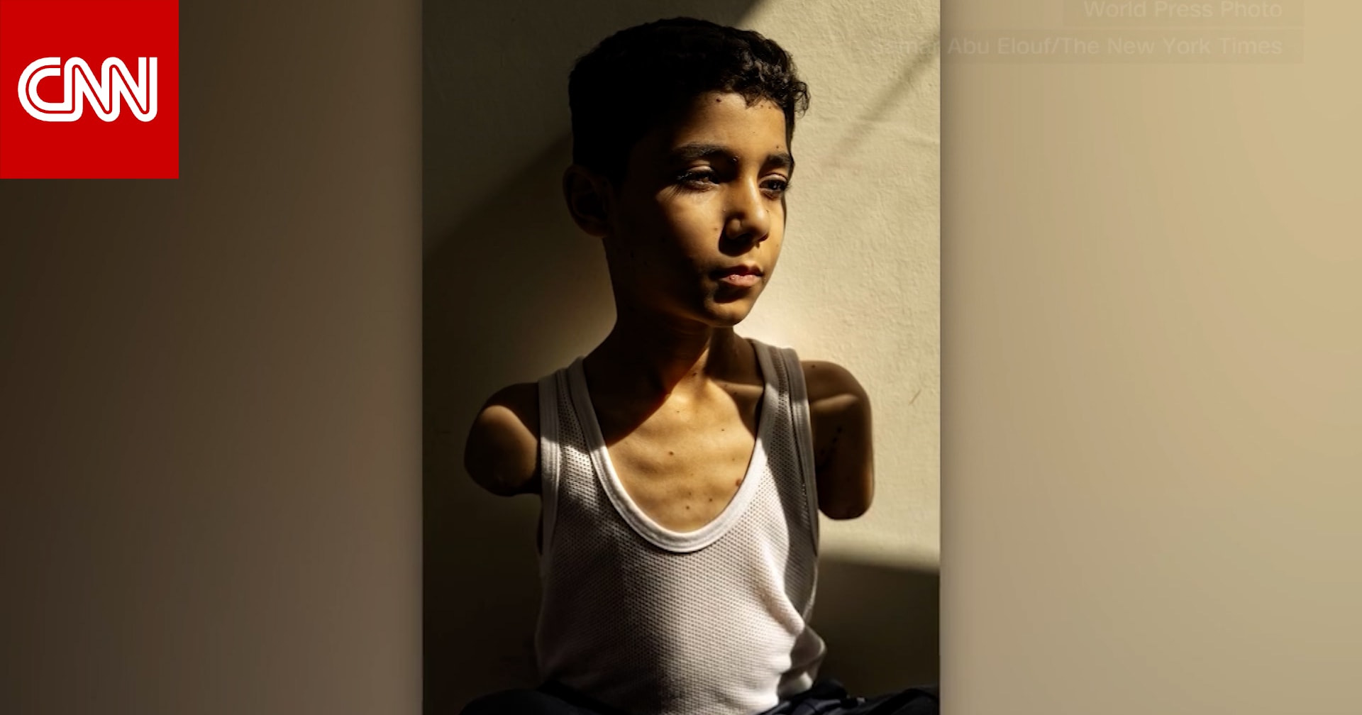 صورة مؤثرة لصبي فلسطيني بُترت يده بغارة إسرائيلية تفوز بجائزة الصورة الصحفية العالمية