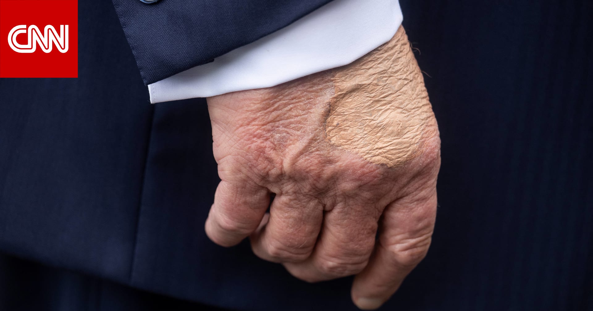 بسبب "كثرة المصافحات".. البيت الأبيض يكشف سبب ظهور كدمات على يد ترامب ويُوضح حالته الصحية