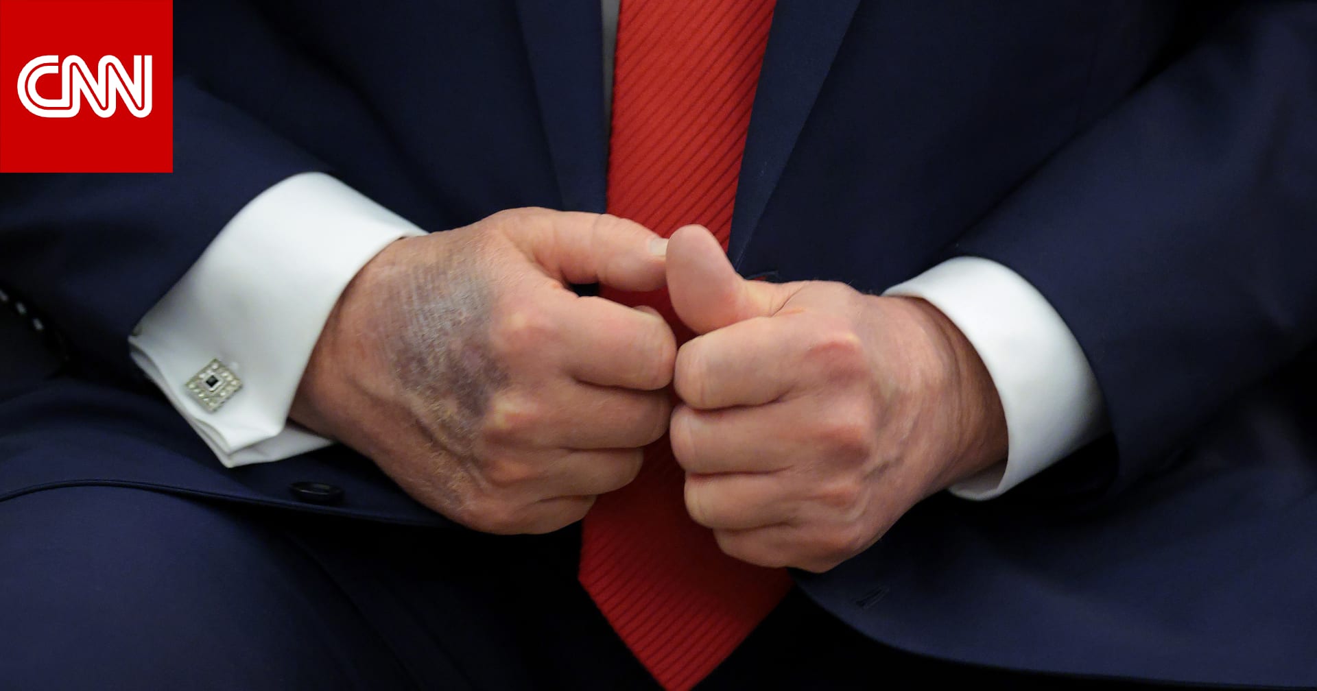 ترامب لـ"وول ستريت جورنال" عن كدمات يده: أريد "دماً لطيفاً ورقيقاً يتدفق عبر قلبي"