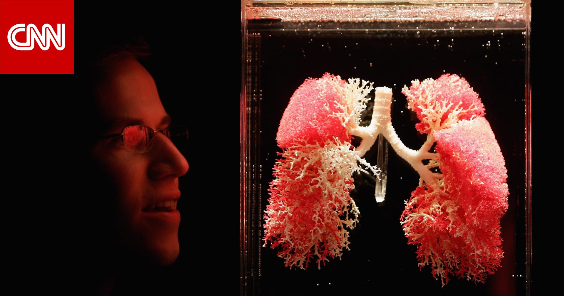 أعراض الجلطة الرئوية..هذه فئة الأشخاص الأكثر عرضة للإصابة بها 