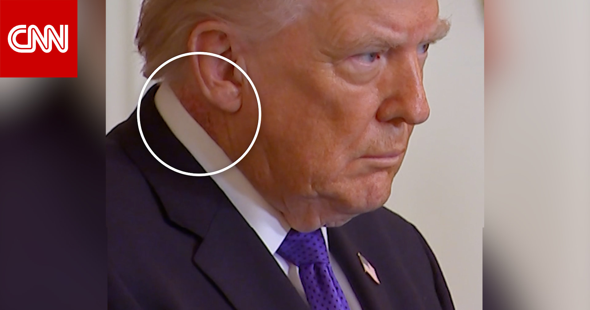 ظهور طفح جلدي جديد على رقبة ترامب.. وتساؤلات بشأن حالته الصحية