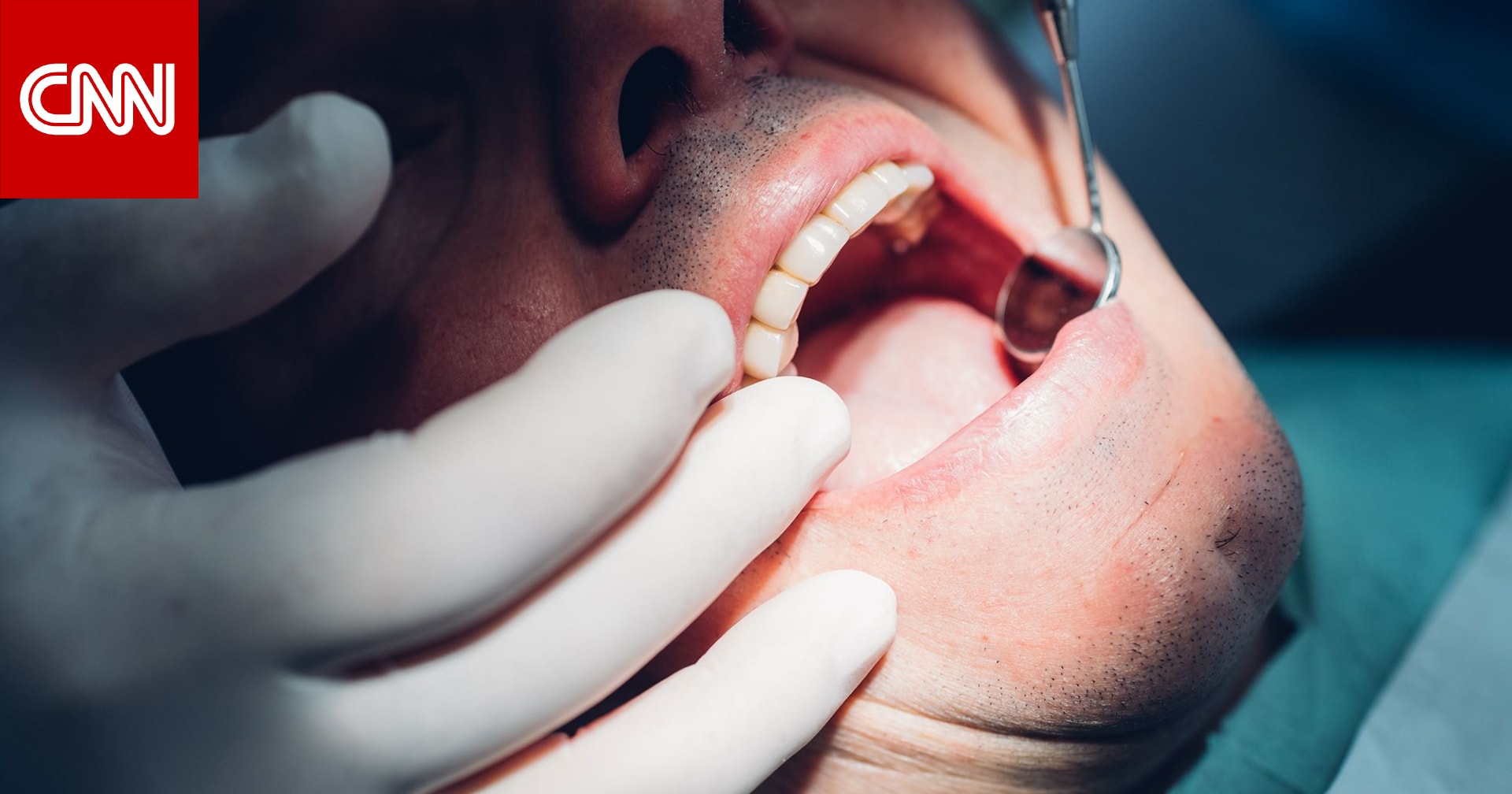 فطريات اللسان.. أعراضها وأسبابها وكيفية علاجها 