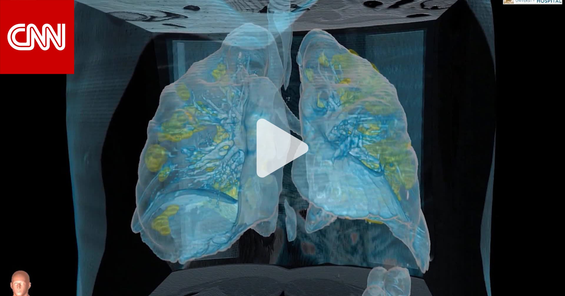شاهد كيف تبدو رئة مصاب بفيروس كورونا وما يحصل داخلها CNN Arabic
