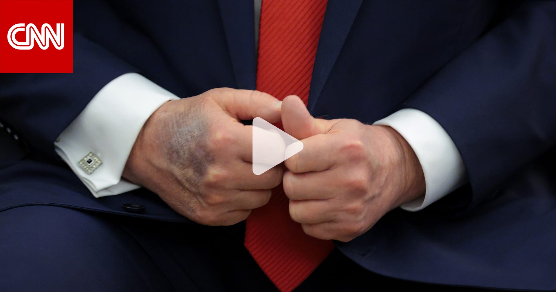 ترامب لـ"وول ستريت جورنال" عن كدمات يده: أريد "دماً لطيفاً ورقيقاً يتدفق عبر قلبي" 