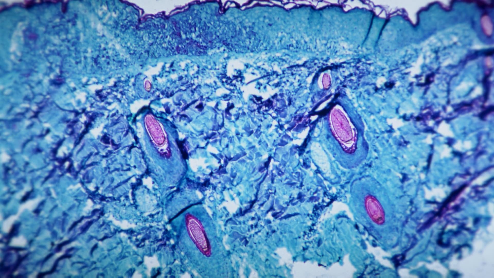 جدري القردة إلى الواجهة مججددًا.. ومراكز مكافحة الأمراض تراقب سلالة أكثر انتشارًا منه