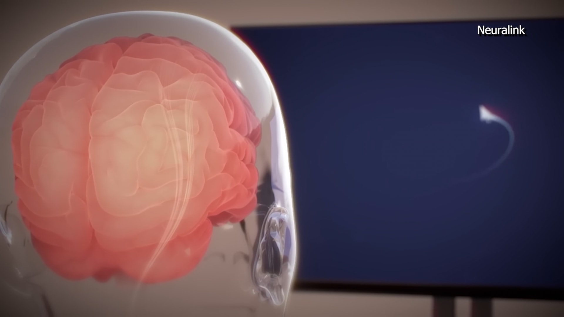 مع بدء زراعة شرائح الدماغ في البشر.. ما هي الفوائد المحتملة لصحتك؟ 1 مع بدء زراعة شرائح الدماغ في البشر.. ما هي الفوائد المحتملة لصحتك؟