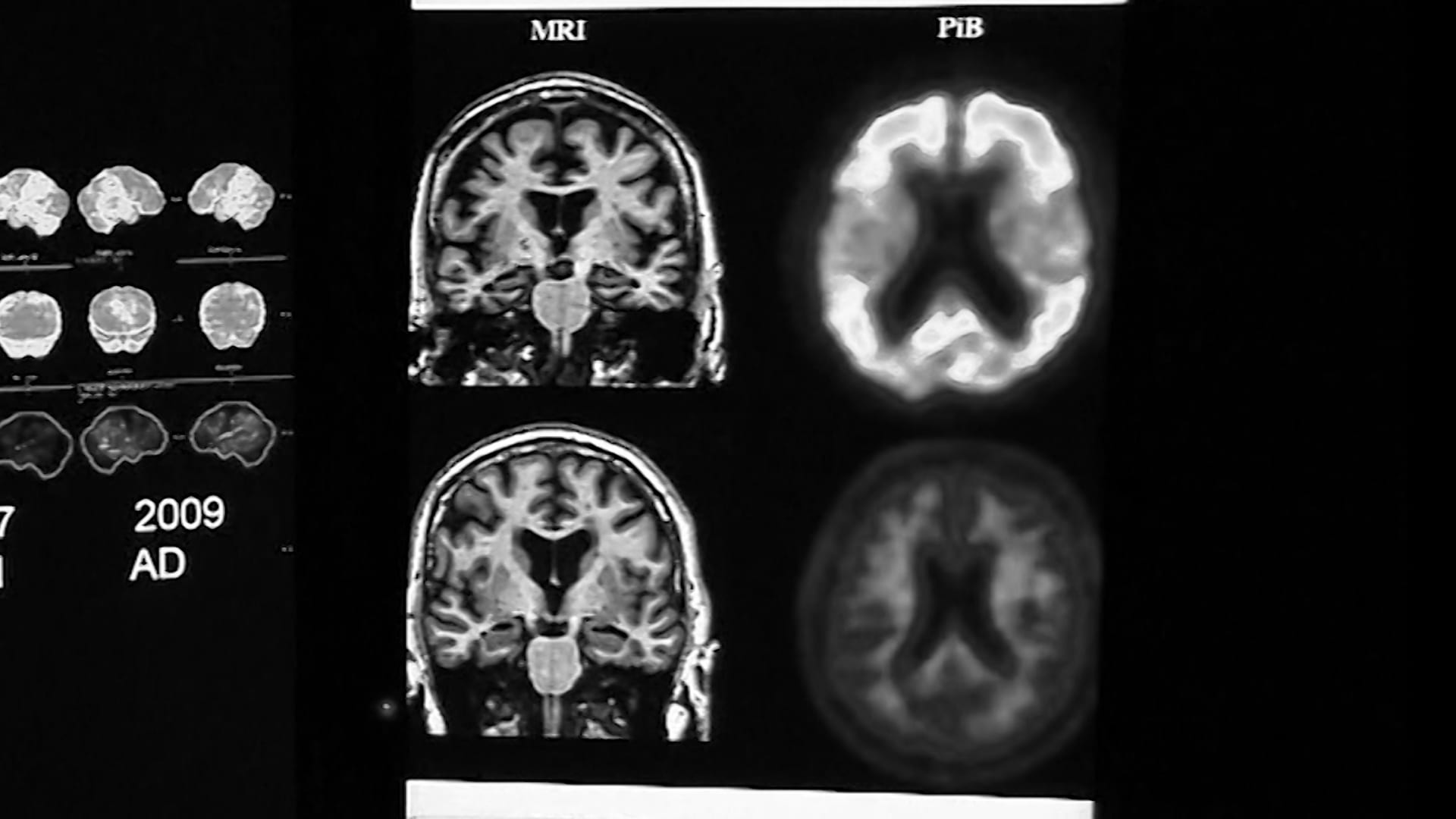 5 أمور تجهلها عن الصرع ربما.. ما هي؟
