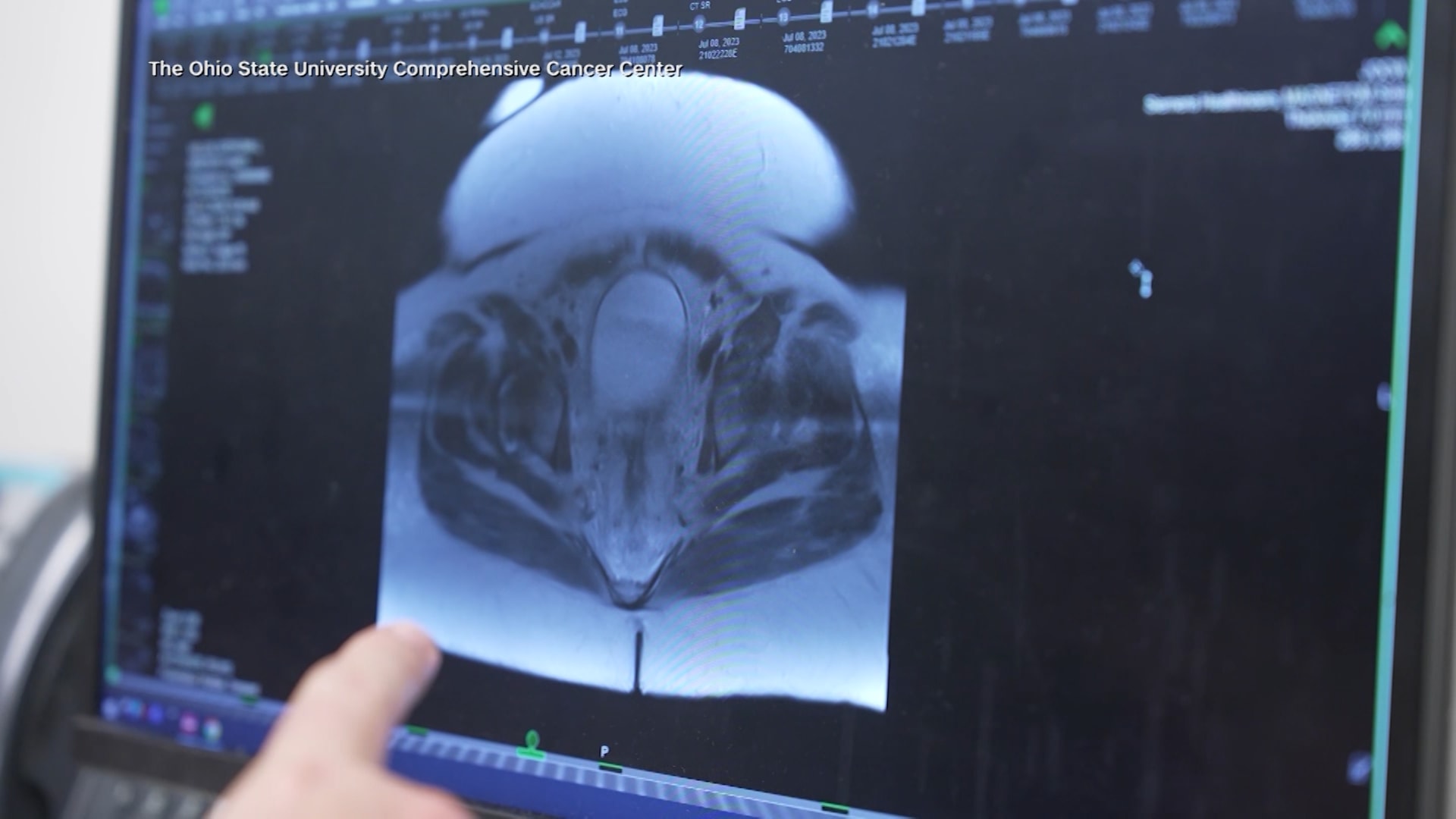 العلامات الأكثر شيوعًا للإصابة بسرطان القولون والمستقيم..ما هي؟