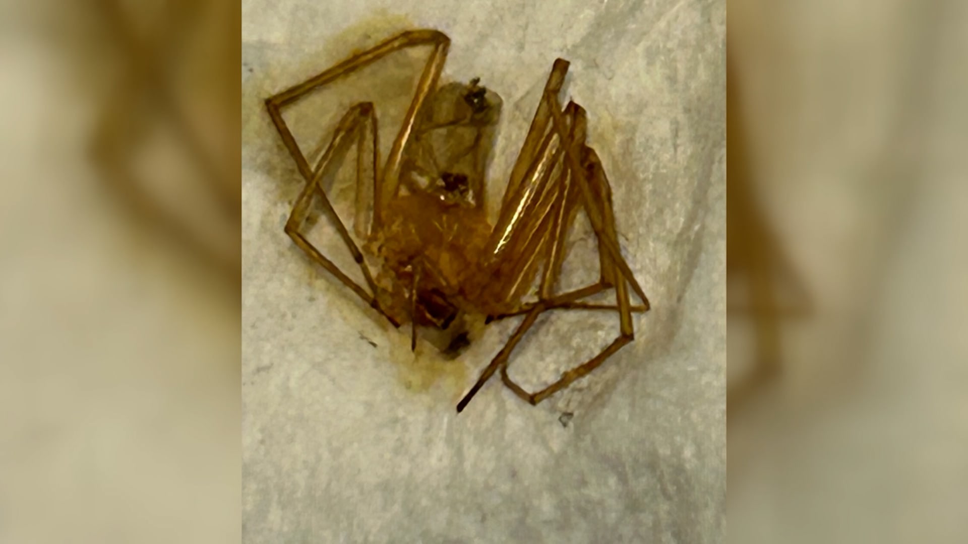 بسبب عضة عنكبوت.. سيدة تضطر لبتر أصابعها بعد تعرضها لعدوى خطيرة