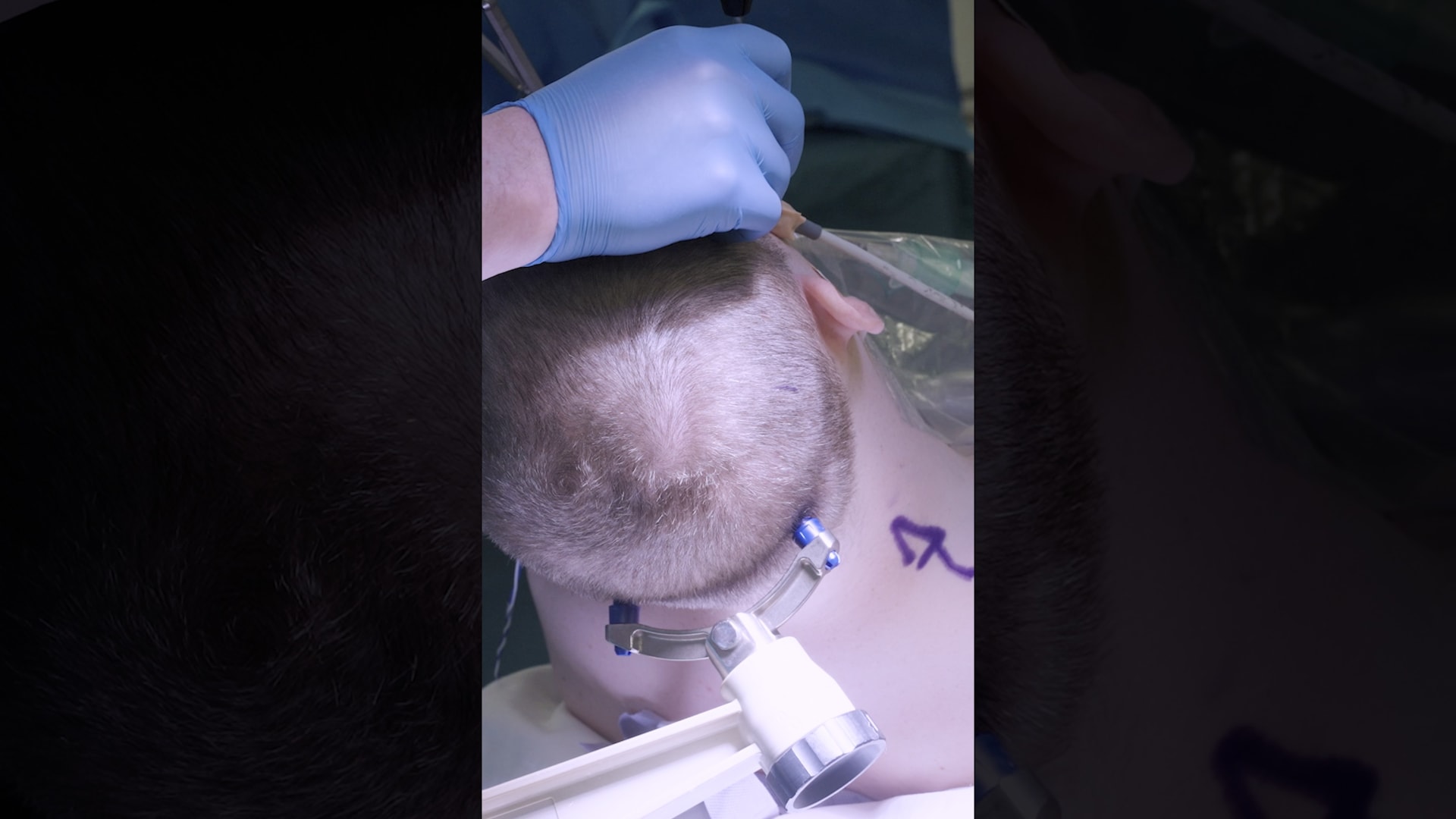 نظرة نادرة داخل عملية جراحية لمريض سرطان يتبرع بجزء من دماغه