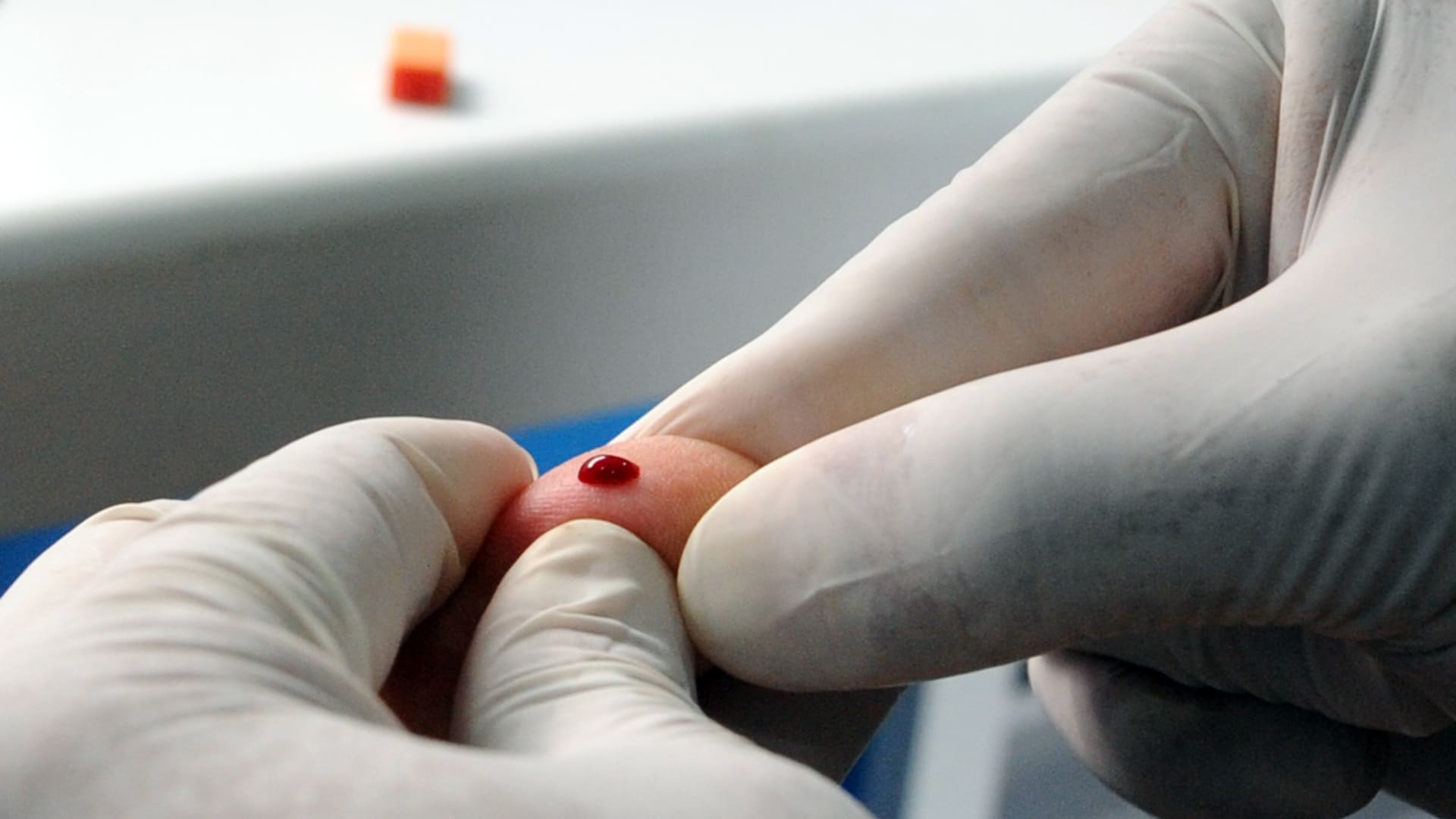ثاني شخص يُعالج من فيروس نقص المناعة البشرية لم يعاوده الفيروس مجدداً بعد عامين
