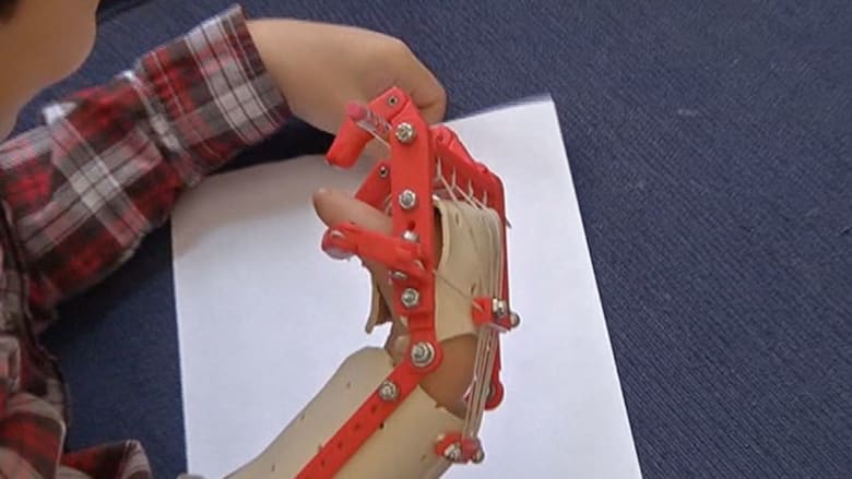 يد بطباعة ثلاثية الأبعاد لطفل دون أصابع