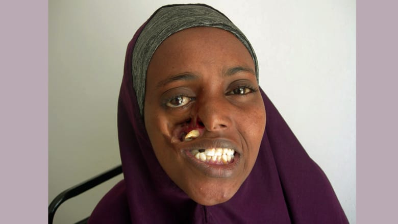 صومالية تنتظر عودة الابتسامة إلى وجهها منذ 23 عاماً صومالية تنتظر عودة الابتسامة إلى وجهها منذ 23 عاماً