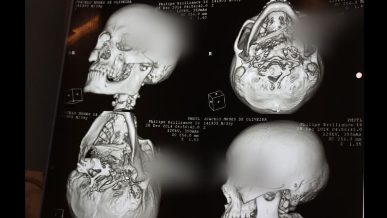 رجل ينجو بأعجوبة بعد طعنه لتظل السكين في رأسه ساعتين حتى وصوله إلى المستشفى رجل ينجو بأعجوبة بعد طعنه لتظل السكين في رأسه ساعتين حتى وصوله إلى المستشفى