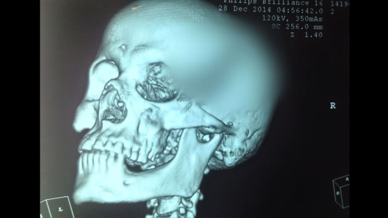 رجل ينجو بأعجوبة بعد طعنه لتظل السكين في رأسه ساعتين حتى وصوله إلى المستشفى رجل ينجو بأعجوبة بعد طعنه لتظل السكين في رأسه ساعتين حتى وصوله إلى المستشفى