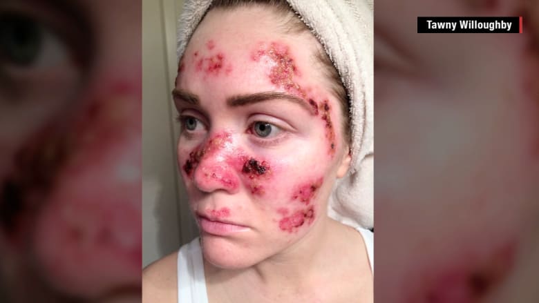 فتاة تصاب بسرطان الجلد وتنشر صورها للتحذير من مخاطر أجهزة تسمير البشرة