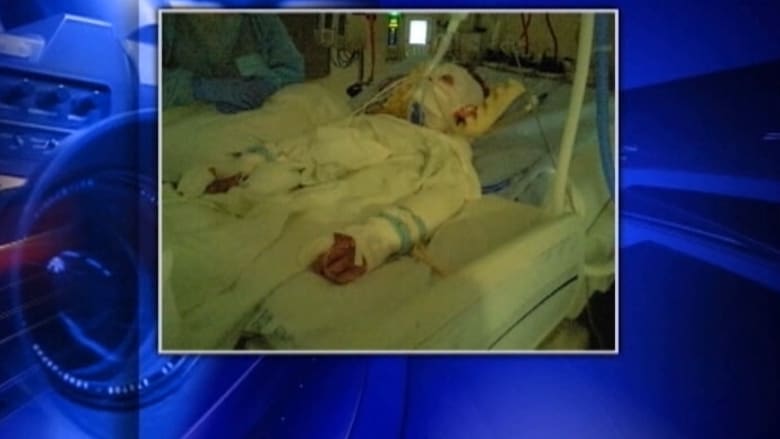 طفل يحترق جراء الألعاب النارية.. وغموض حول طبيعة المادة المتفجرة