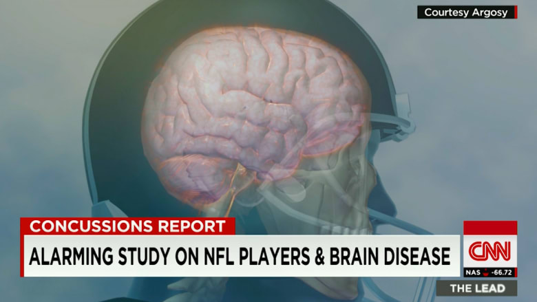 دراسة مثيرة للقلق تشير إلى احتمال إصابة الرياضيين بأمراض في الدماغ