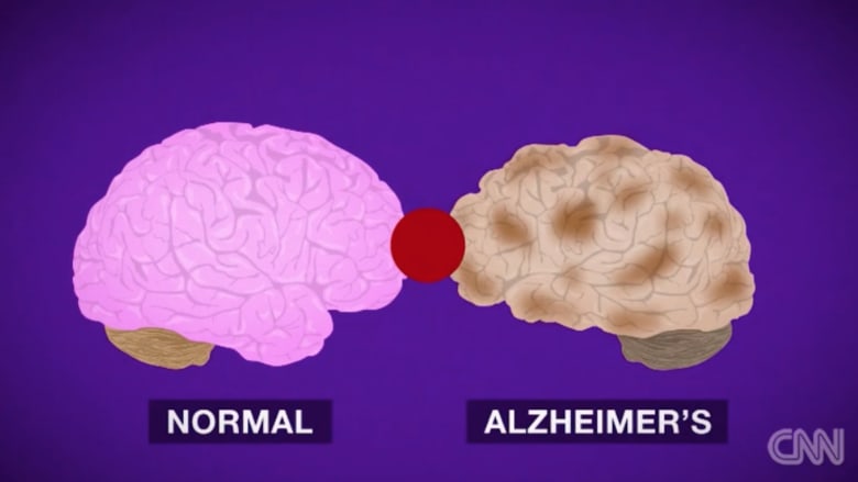 بالفيديو.. هذا ما يفعله مرض الزهايمر بالدماغ