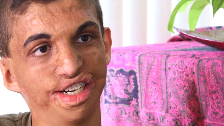 بالفيديو: كيف يعيش يوسف في أمريكا بعد حرقه من قبل مقنعين في بغداد
