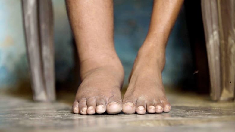 يعتقد البعض أن سببه لعنة.. ما هو داء الفيل الذي يصيب الملايين حول العالم؟
