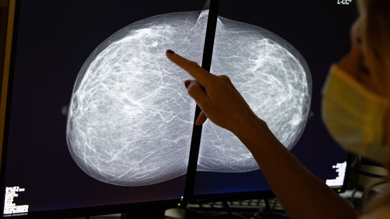 علاج جديد لسرطان الثدي؟ هذا الدواء يمكن أن يغير الطريقة التي يعالج بها الأطباء مرضى السرطان