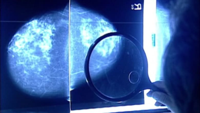 هل سيكون هذا العلاج الموعود للمصابين بسرطان الثدي المتقدم؟
