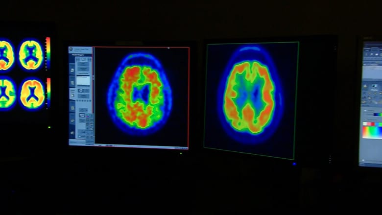 هل سبق لك أن تعرضت لإصابة دماغية؟ دراسة جديدة تكشف عن المدة الحقيقية للتعافي