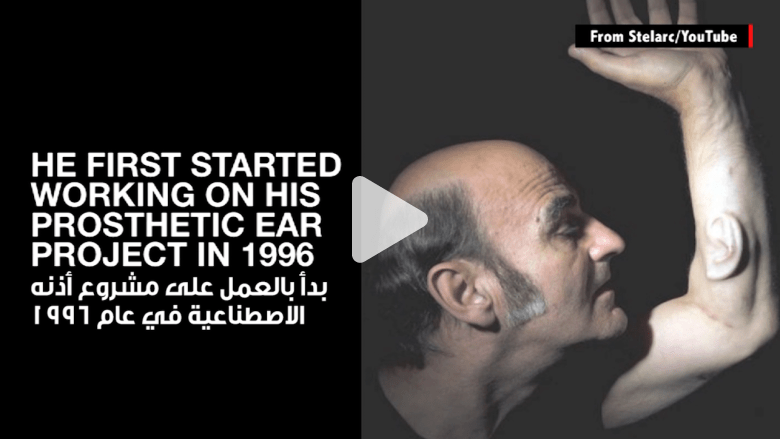 لن تصدق هذا.. رجل يزرع أذناً في ذراعه! لن تصدق هذا.. رجل يزرع أذناً في ذراعه!