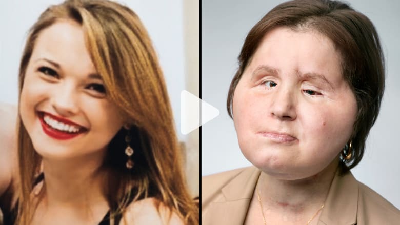 عملية زرع وجه تاريخية لناجية من محاولة انتحار عملية زرع وجه تاريخية لناجية من محاولة انتحار