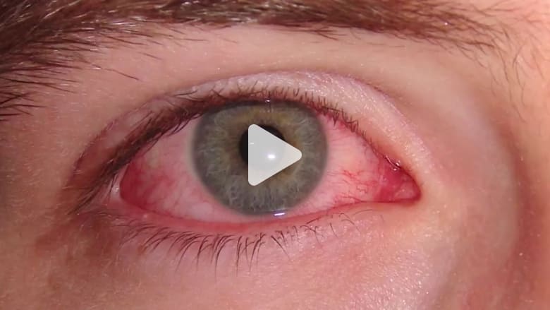 ما أسباب ظهور الدم في زاوية العين Cnn Arabic