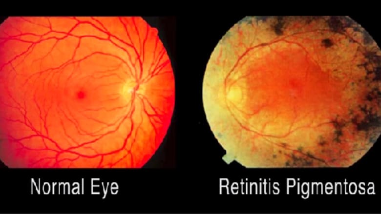 خطوة طبية تكنولوجية.. اختراع يعيد للمصابين بالعمى جزءاً من نظرهم