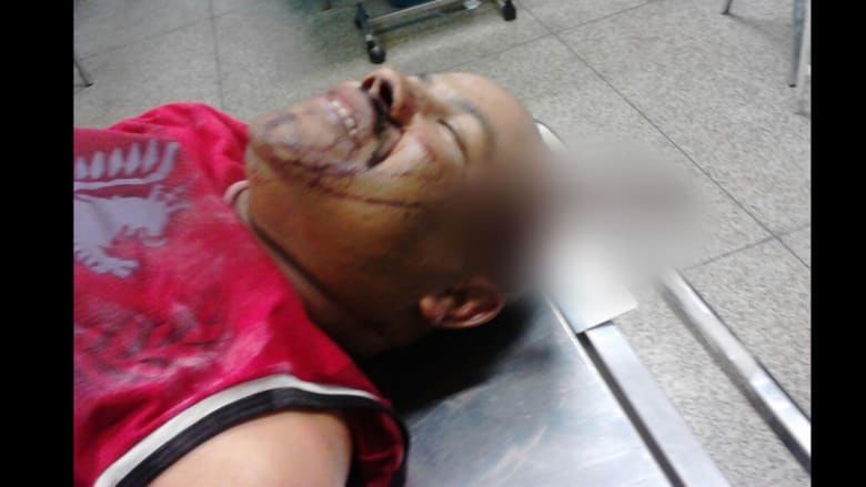 رجل ينجو بأعجوبة بعد طعنه لتظل السكين في رأسه ساعتين حتى وصوله إلى المستشفى