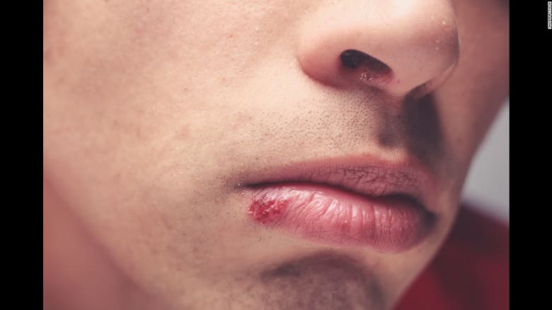 الجانب "المظلم" للتقبيل... قد يصيبك بأحد هذه الأمراض 
