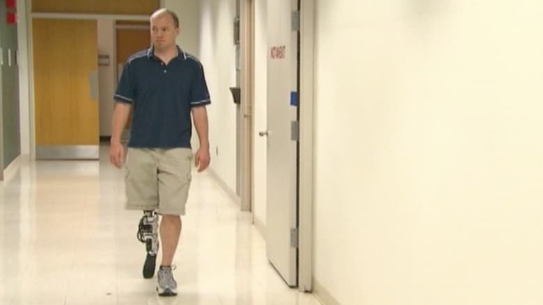 ساق اصطناعية ذكية تسمح لمبتوري الأرجل بالمشي الطبيعي