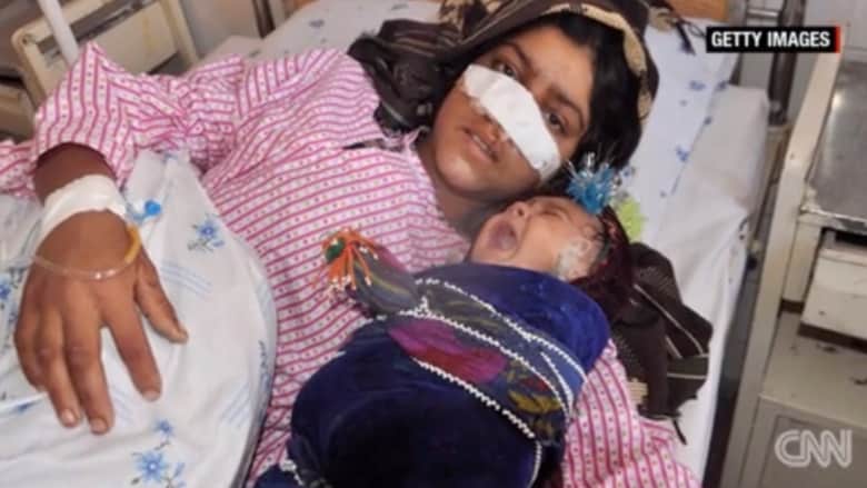 بالفيديو: أفغاني يقطع أنف زوجته بسبب "الغيرة"