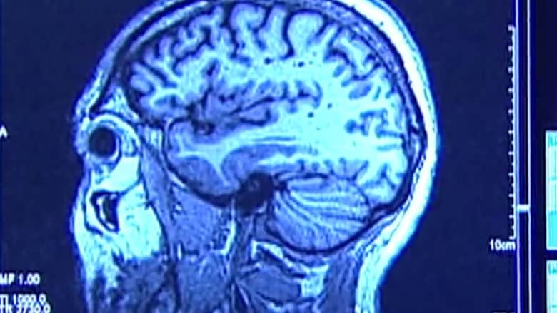 دراسة: مستويات عالية من التوتر يمكن أن تسبب تقلص دماغك