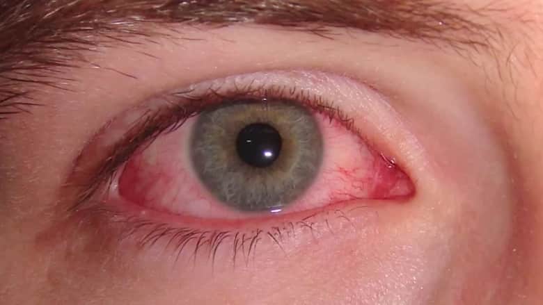 ما أسباب ظهور الدم في زاوية العين؟