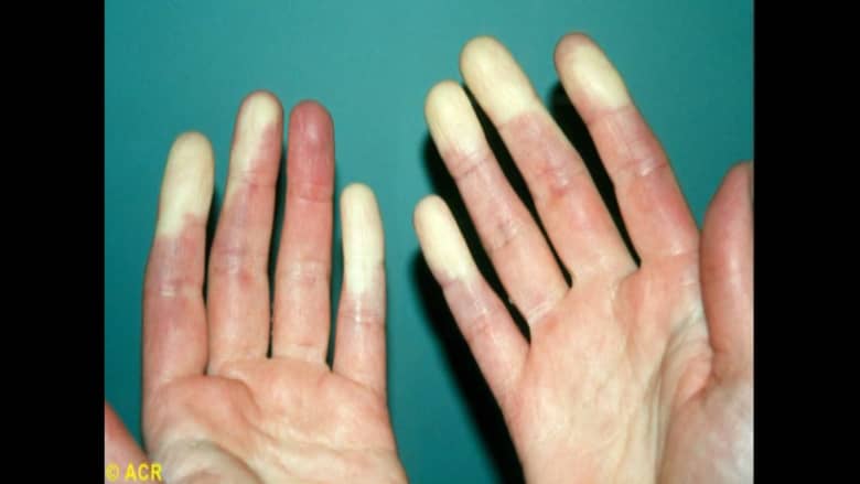 قد يتسبب في تغيير لون يديك وأصابع قدميك.. ما هو مرض رينود الأولي؟