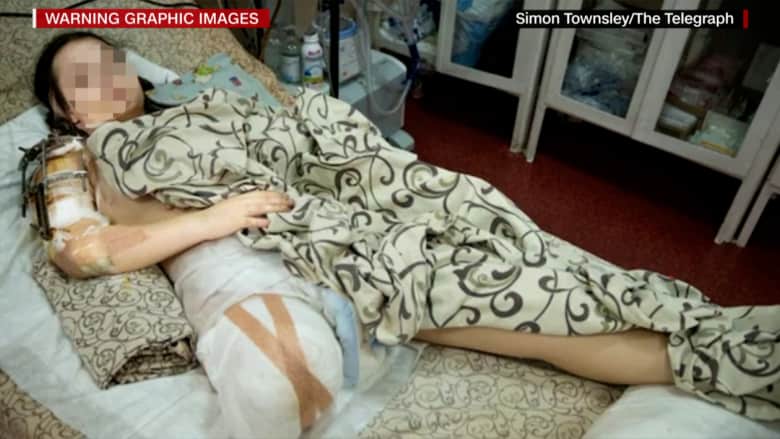 صور تعكس "أهوال الحرب".. فتاة أوكرانية على سرير المستشفى مبتورة الساق بعد إصابتها بشظية
