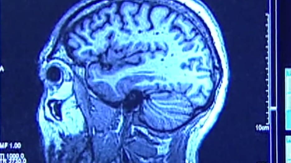 دراسة: مستويات عالية من التوتر يمكن أن تسبب تقلص دماغك