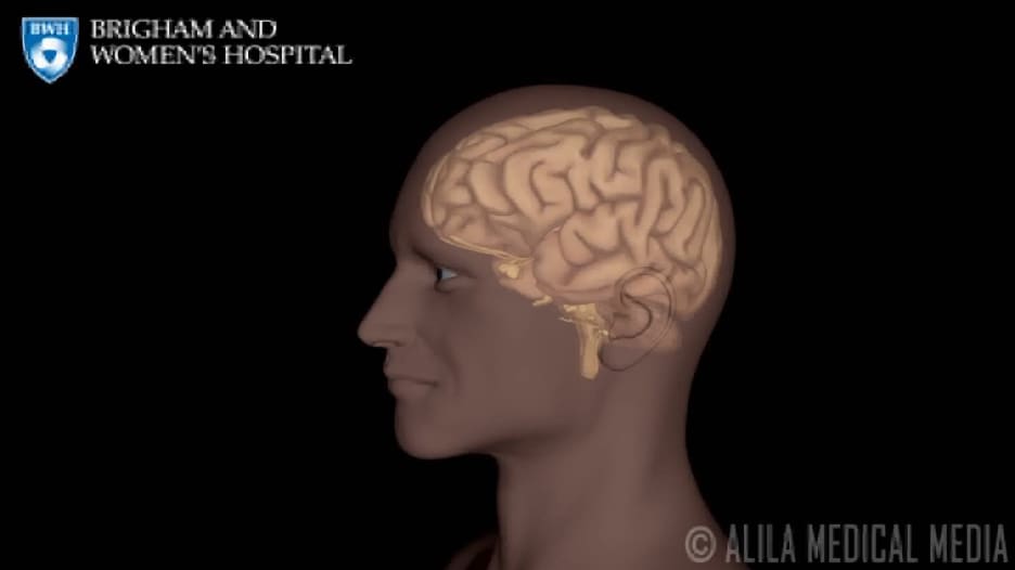 تستمر لبضع دقائق فقط لكنها علامة حمراء للسكتات الدماغية المستقبلية.. ما هي النوبات الإقفارية العابرة؟