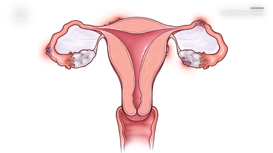 حقنة جديدة يمكن أن توفر الراحة للنساء اللواتي يعانين من حالات الانتباذ البطاني الرحمي